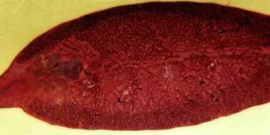 trematodo parasitoa nola kendu gorputzetik